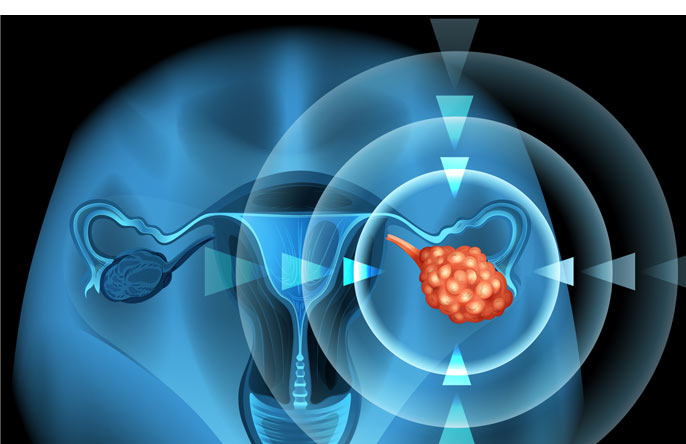 diagnozowanie raka jajnika rozpoznanie i objawy raka jajnika